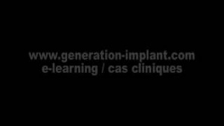 Implants Dentaires  Communication buccosinusienne et comblement de sinus [upl. by Doug]