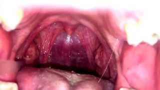 Slow Mo Tonsil Stone Removal [upl. by Elmina183]