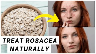 DIY Rosacea Treatments Natural Remedies That Actually Work  Skincare Tips [upl. by Mccafferty]