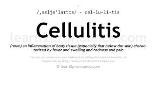 Pronunciation of Cellulitis  Definition of Cellulitis [upl. by Dorothee]