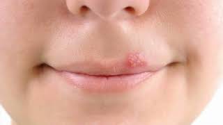 Difference Between Cold Sore and Fever Blister [upl. by Royall986]