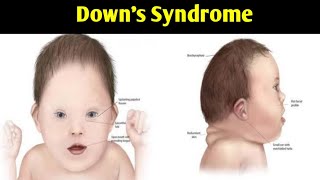 Downs Syndrome Mongolism  Trisomy Of 21 Chromosome  Autosoml NonDisjunctio [upl. by Marlane25]