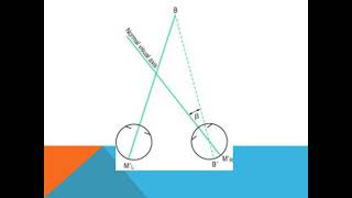 ANOMALOUS RETINAL CORRESPONDENCE optometry eyecare ophthalmology optics vision subscribe [upl. by Osrit]