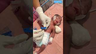 Umbilical Cord Clam Changed medical newbornbaby nicu [upl. by Lukey]