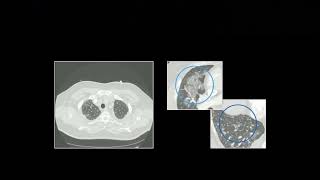 Acute Pulmonary Presentations Part 1  Free Radiology CME [upl. by Judye243]