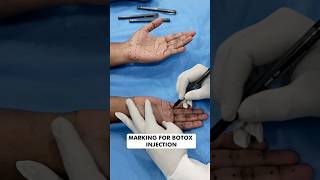 Botox Treatment for Palmar Hyperhidrosis at Skinaa Clinic viral shorts [upl. by Valiant]