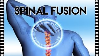 CCO CPC Exam Exercises — Spinal Fusion Practice Exam Question [upl. by Encratis234]