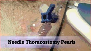 Needle Thoracostomy Pearls [upl. by Huai]