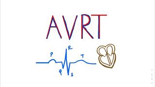 Atrioventricular Reentrant Tachycardia AVRT SVT ECGTUTORIAL cardiology medicalstudents AVNRT [upl. by Dambro]