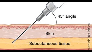 Subcutaneous Route of Drug administration  Advantages and Disadvantages [upl. by Adelind720]