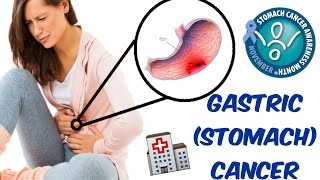 Gastric Cancer Stomach Adenocarcinomas Lymphomas GISTs And Carcinoids [upl. by Eninaej118]