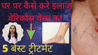 पाँवो की नस फूल जाने Varicose Veins का इलाज Varicose Veins treatment by Dr Nikita [upl. by Rabjohn]