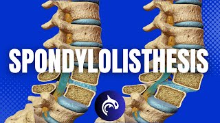 Understanding Spondylolisthesis amp Treatments 3D Animation [upl. by Olivier]