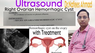 Ultrasound Right Ovarian Hemorrhagic Cyst doctor motivation viral ultrasound treatment [upl. by Aromat]