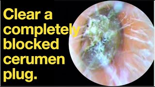 Clear a completely blocked cerumen plug ear wax removal  ear cleaning  ASMR  relaxation  relax [upl. by Dart]