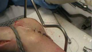 Palm and sole suture on a cadaver foot [upl. by Eimot]