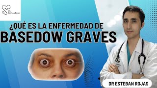 ¿Qué es la enfermedad de Basedow Graves [upl. by Ahusoj]