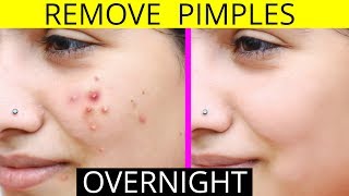 How To Remove Pimples Overnight  Acne Treatment  Anaysa [upl. by Acilejna840]