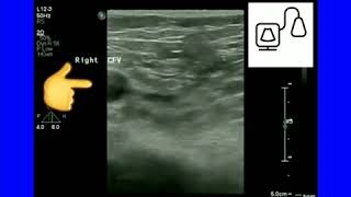 Ultrasound Physics [upl. by Alidis]