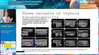 Ushakov AV Pathogenesis of thyroid stromal swelling  BGRSSB2024 [upl. by Sears]