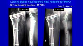 Complex Proximal Femur Fractures [upl. by Elimay]