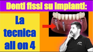 La guida definitiva Denti fissi su 4 impianti  all on four [upl. by Pardew]