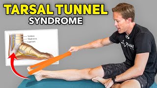 5 Home Exercises for Tarsal Tunnel Syndrome [upl. by Cullin]