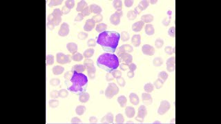 NPM1 mutated Acute Myeloid Leukaemia [upl. by Orsola278]