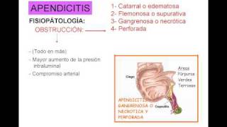 APENDICITIS 2avi [upl. by Oly]