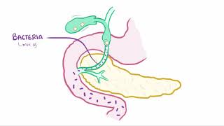 Ascending cholangitis acute cholangitis causes symptoms diagnosis amp pathology [upl. by Adnamra]