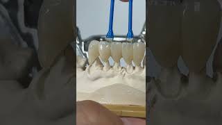 Engaged 5 unit ceramics for perio problems patient [upl. by Gwyneth]