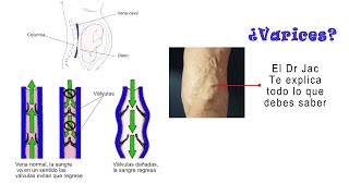 Venas varicosas o varices [upl. by Rehpotsirahc535]