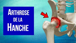 Arthrose de la hanche  Explication et Traitement [upl. by Latisha996]