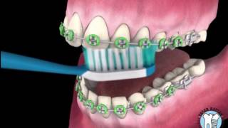 Ortodontik Diş Fırçalama Tekniği ve Diş Teli Varken Dişler Nasıl Fırçalanır [upl. by Axel990]