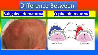 Variation Between Subgaleal Hematoma and Cephalohematoma [upl. by Rhyner]