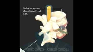 Epidural steroid Injection Translaminar Approachmov [upl. by Cook]