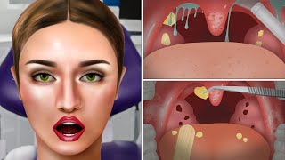 ASMR Cause of bad breath Tonsil stone removal animation  Mouth Treatment Animation [upl. by Esilanna]