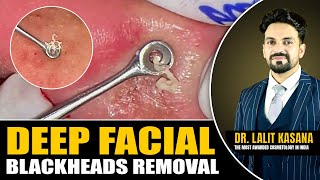 Deep Facial Blackheads Removal [upl. by Kavanaugh]