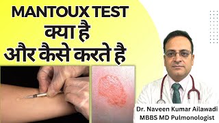 Mantoux Test क्या है और कैसे करते है  Mantoux tuberculin skin test TST TB Test  Diagnosis of TB [upl. by Assin934]