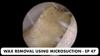 EAR WAX REMOVAL USING MICROSUCTION  EP 47 [upl. by Warde]