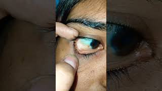 Conjunctival granuloma cyst chronic [upl. by Xanthe362]