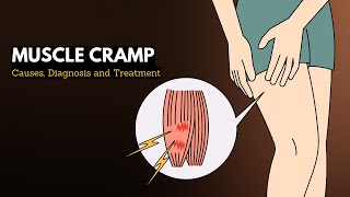 Muscle cramp Causes Signs and Symptoms Diagnosis and Treatment [upl. by Udela786]