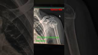 Proximal humerus fracturexray subscribe support ytshorts viralshorts [upl. by Bandler]