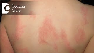 What happens in Hives and Angioedema  Dr Nischal K [upl. by Guria13]