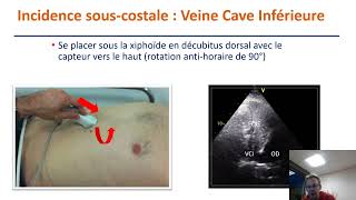 Incidences standards en échocardiographie transthoracique [upl. by Alessandra128]