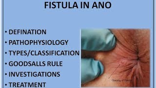 FISTULA IN ANO HINDI [upl. by Wurst735]