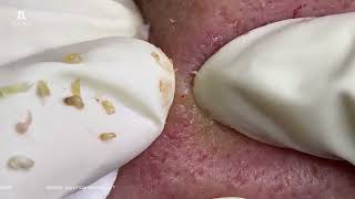 Big Cystic Acne Blackheads Extraction Blackheads amp Milia Whiteheads Removal Pimple Popping [upl. by Janel]