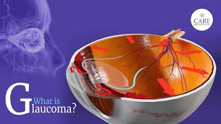 What is Glaucoma  What are the Causes and Common Types of Glaucoma  CARE Hospitals [upl. by Letnom]