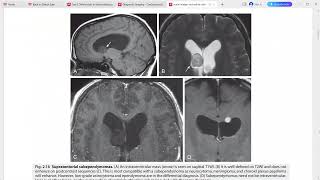 CORE REQUISITES of neuroradiology [upl. by Yliram35]