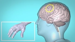 Repetitive Transcranial Magnetic Stimulation rTMS and Hand Therapy [upl. by Mcdowell]